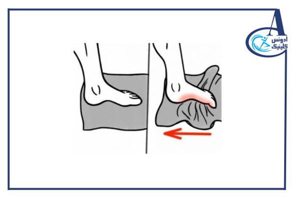 تمرینات کششی برای صافی کف پا - ادونس کلینیک